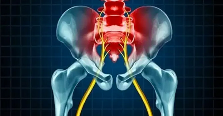 Sciatica-image