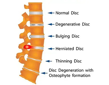 common-disc-conditions-treated-with-spinal-decompression-1920w