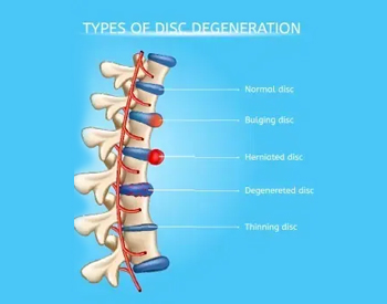 disc-injuries-treated-with-chiropractic-care-round-rock-tx-1920w