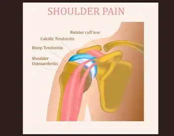 osteoarthritis-1920w