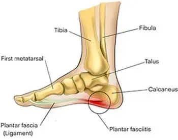 what+is+plantar+fascitis+foot+pain-1920w